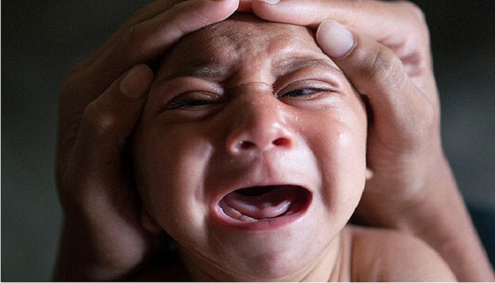 Ученые нашли связь между вирусом Зика и микроцефалией